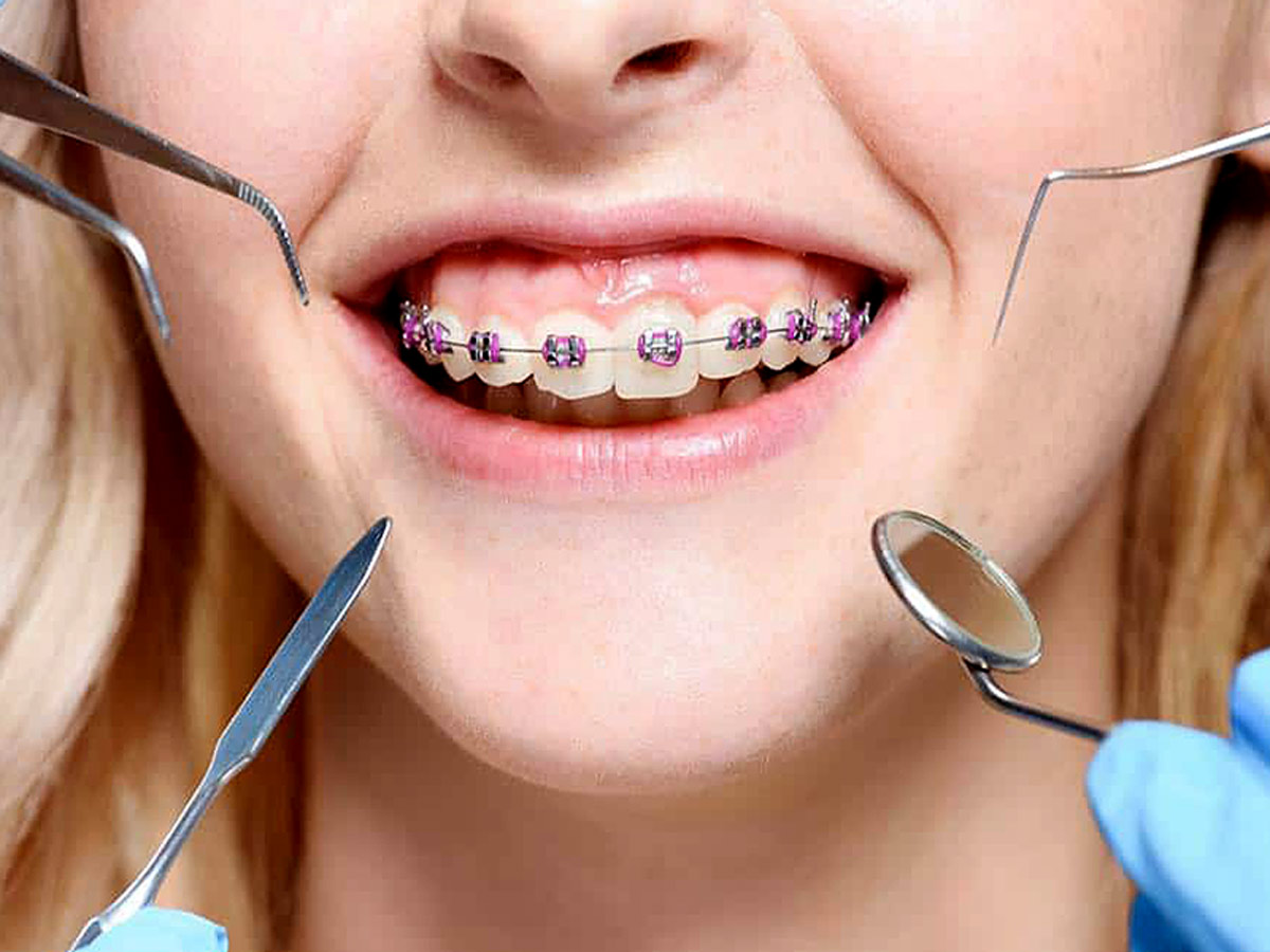 Orthodontist Braces