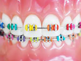 blue braces colors