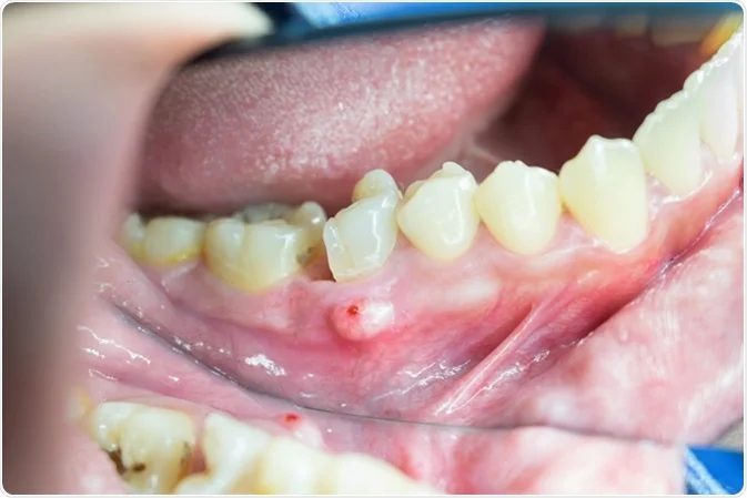 Symptoms Of Abscess Tooth
