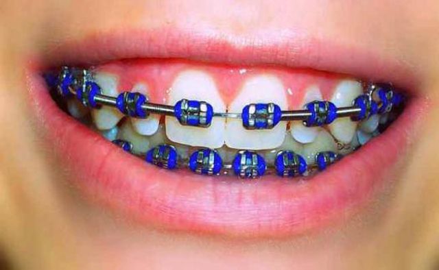blue braces colors